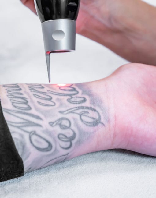 tattoo removal